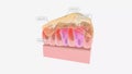 At the cellular level, excess bacteria summon high numbers of immune cells called neutrophils to the infected airways.