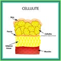 Cellulite. The anatomical structure of the adipose tissue. Infographics. Vector illustration on isolated background Royalty Free Stock Photo