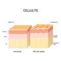 Cellulite. Cross section of a healthy skin and skin with Orange peel Royalty Free Stock Photo