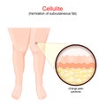 Cellulite. Females legs. human skin with Orange peel syndrome