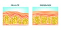 Cellulite formation.