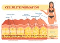 Cellulite formation vector illustration diagram, medical information scheme. Royalty Free Stock Photo