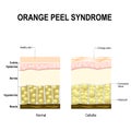 Cellulite or orange peel syndrome