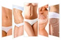 The cellulite removal plan. White markings on young woman body