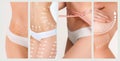 The cellulite removal plan. White markings on young woman body Royalty Free Stock Photo