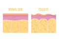 Cellulite skin and healthy skin anatomy. Fat tissue of human body