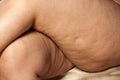 Cellulite and stretch marks Royalty Free Stock Photo