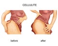 Cellulite on a woman s thigh