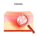 Cellulitis. bacterial infection of the fat through a magnifying glass