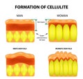 Cellulitis and skin aging in men and women. Infographics. Vector illustration on background