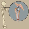 Cementless Arthroplasty Prosthesis vector illustration Royalty Free Stock Photo