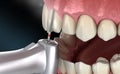 Central Incisor preparation process for dental Veneer placement. Medically accurate 3D illustration Royalty Free Stock Photo