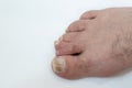 Central polydactyly on human foot toe  on white background Royalty Free Stock Photo