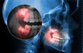 Cephalometric and displaying toothache zoom