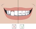 Ceramic braces and crooked teeth with a smile as a treatment concept in a dental or orthodontic clinic, a vector stock