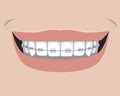 A ceramic braces with incisors and molars, a flat vector stock illustration with a smile as a concept of dental treatment and