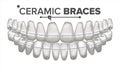 Ceramic Braces Vector. Human Jaw. Dentist, Orthodontist Poster Element. 3D Realistic Isolated Illustration