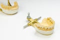 ceramic bridge to the upper jaw on implants. concept of orthopedic dentistry