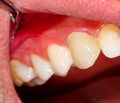 Ceramic crown on tooth