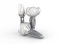 Ceramic crowns, custom implant abutment and implantats. Medically accurate 3D illustration of dental implantation