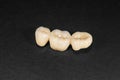 Ceramic crowns of human teeth closeup macro isolate on black background. The concept of aesthetic dentistry Royalty Free Stock Photo