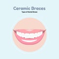 Ceramic Dental Braces.