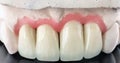 Ceramic dental bridge on plaster model. Dental prosthesis manufacturing workshop. Full wax denture. Selective focus Royalty Free Stock Photo