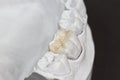 ceramic dental inlay
