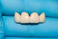 Ceramic denture. Ceramic-metal bridge of human teeth in the hands of a dentist in blue gloves. Close-up. Macro