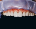 Finished ceramic front crowns, black background. 8 units dental veneers Royalty Free Stock Photo