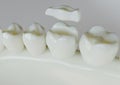 Ceramic Inlay crown over a tooth- 3D Rendering Royalty Free Stock Photo