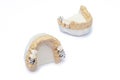 Ceramic-metal bridges on the models of the upper and lower jaws. prosthetics of damaged and missing teeth