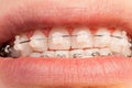 Ceramic and metal orthodontic cases on teeth