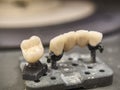 Ceramic metal teeth, partial ceramicmetal bridge