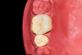 Ceramic molar onlay