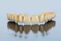 Ceramic teeth - dental bridge Royalty Free Stock Photo