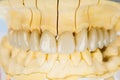 Ceramic teeth - dental bridge