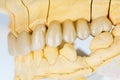 Ceramic teeth - dental bridge