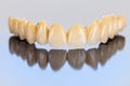 Ceramic teeth - dental bridge Royalty Free Stock Photo