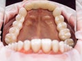 Ceramic teeth dental crowns on model. Ceramic veneers metal free. Metal Free Ceramic crowns on model in dental clinic Royalty Free Stock Photo