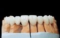 Ceramic teeth with the implant on a plaster model isolated on a black background. Zirconium crowns