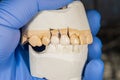Ceramic tooth crown close-up on a plaster model. dental prosthesis Royalty Free Stock Photo
