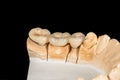 Ceramic tooth crowns and metal pins close-up macro. Orthopedic dentistry restoration of decayed teeth