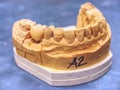 Ceramic and zirconium crowns of human tooth on a model