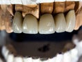 Ceramik tooth