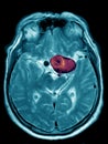 Cerebral aneurysm, illustration, MRI