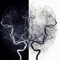 Cerebral angiography  image from Fluoroscopy in intervention radiology  showing cerebral artery Royalty Free Stock Photo