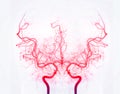 Cerebral angiography  image from Fluoroscopy in intervention radiology  showing cerebral artery Royalty Free Stock Photo