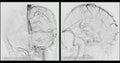 Cerebral angiography  image from Fluoroscopy in intervention radiology  showing cerebral artery Royalty Free Stock Photo