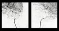 Cerebral angiography  image from Fluoroscopy in intervention radiology  showing cerebral artery Royalty Free Stock Photo